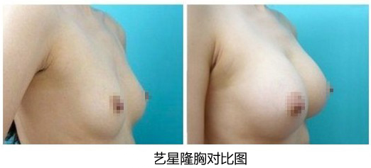 假体隆胸前后对比图